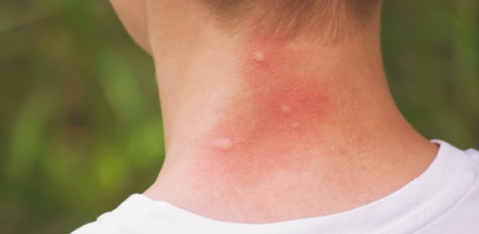What is the difference between Bed Bug Bite and Mosquito Bite?